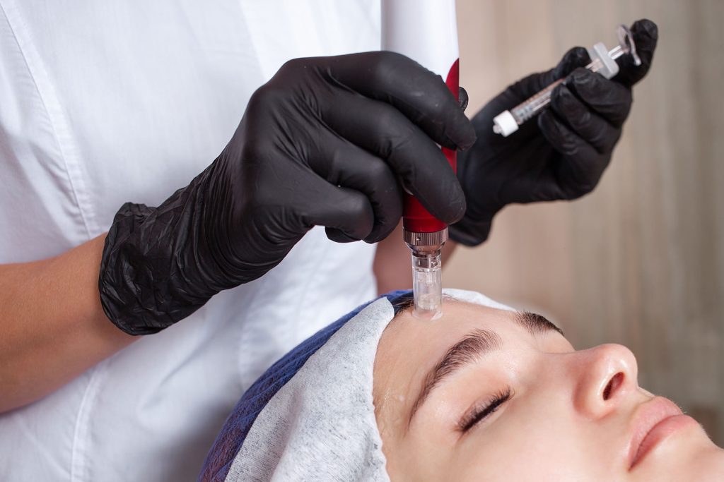 Acne scar microneedling treatment at Aterna Wellness
