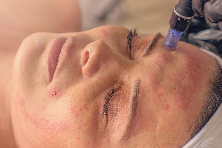 Microneedling treatment for glowing skin at Aterna Wellness