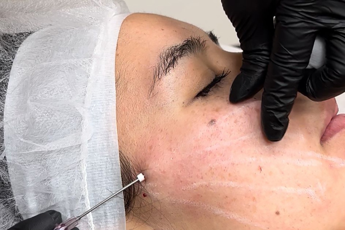 Non surgical facial lifting treatment at Aterna Wellness