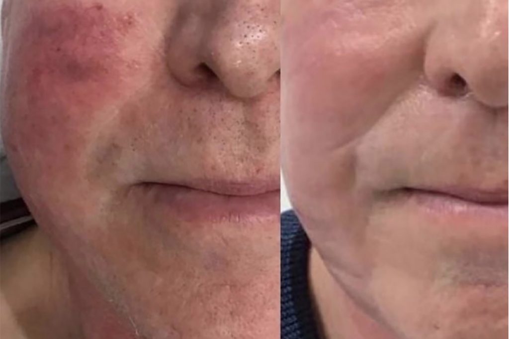 Pigmentation correction treatment at Aterna Wellness