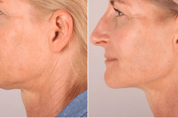 Radiesse collagen treatment at Aterna Wellness