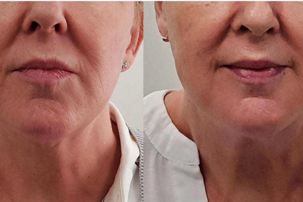Advanced skin rejuvenation treatment at Aterna Wellness