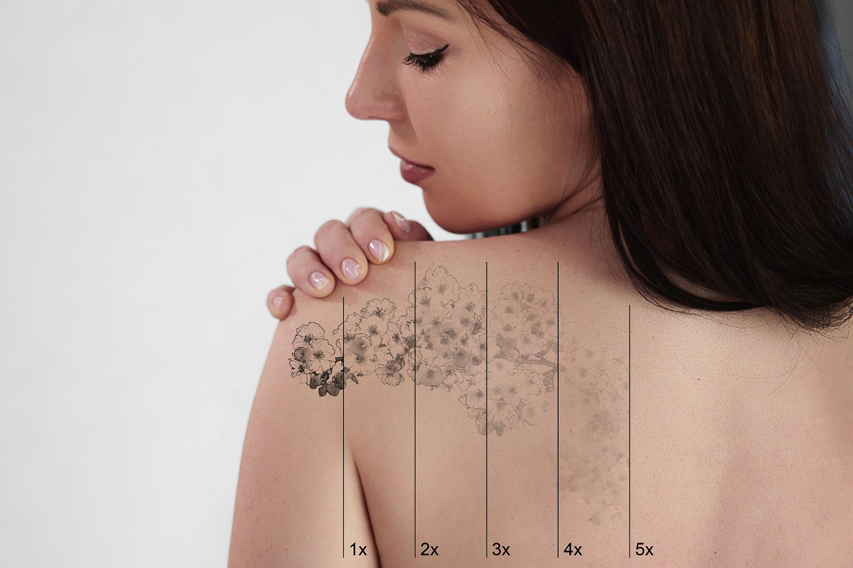 Laser tattoo removal at Aterna Wellness